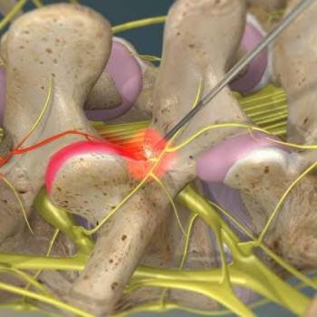 Dr Milon.V.Mitragotri Hubballi-Radiofrequency (RF) ablation is an effective treatment for managing chronic pain